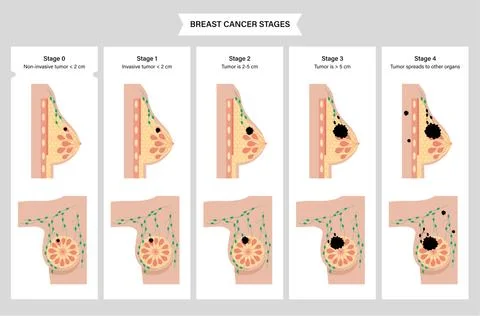 Breast disease concept Stock Illustration
