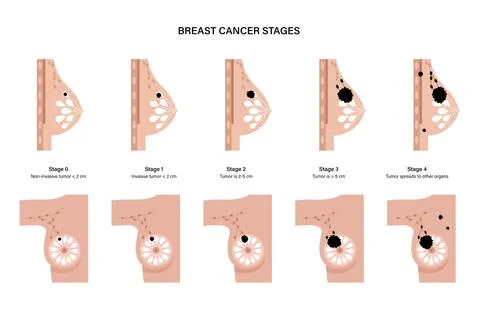 Breast disease concept Stock Illustration