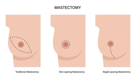 Breast disease concept Illustrazione stock
