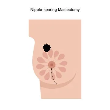 Breast disease concept Stock Illustration