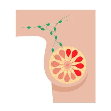 Breast disease concept Stock Illustration