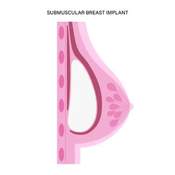 Breast Implant Concept Illustration