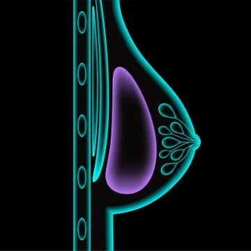 Breast Implant Concept Illustration