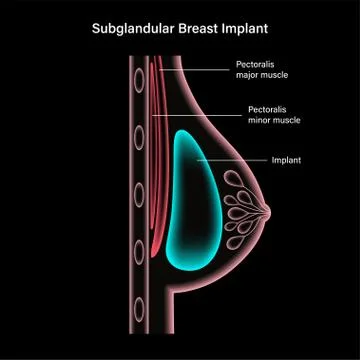 Breast Implant Concept Illustration