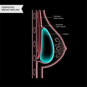 Breast Implant Concept Illustration