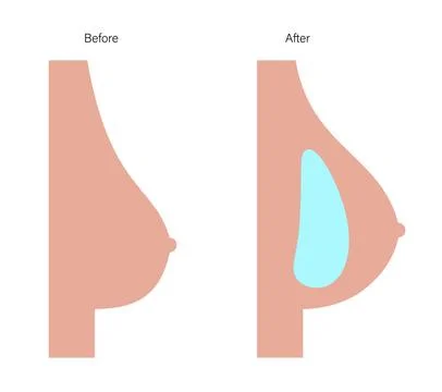 Breast Implant Concept Illustration