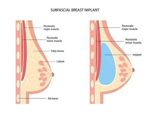 Breast Implant Concept Illustration