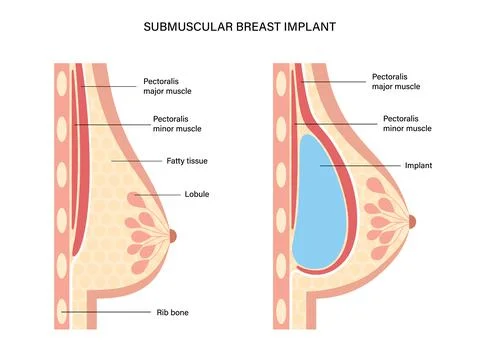 Breast Implant Concept Illustration