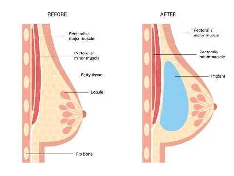 Breast Implant Concept Stock Illustration