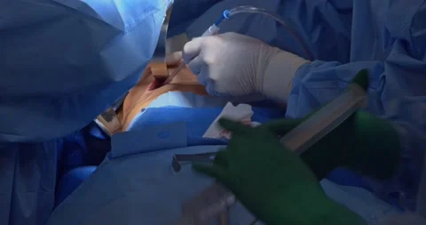 Breast implant replacement. Plastic surgery Stock Footage 204026387