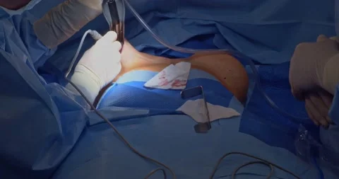 Breast implant replacement. Plastic surgery 動画素材 204026827