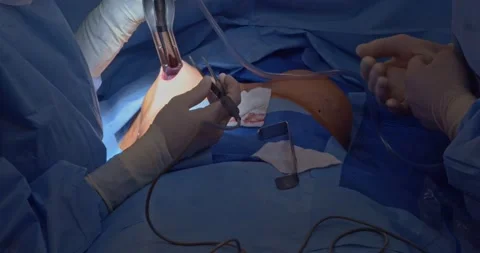 Breast implant replacement. Plastic surgery 動画素材 204027112