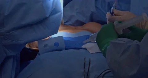 Breast implant replacement. Plastic surgery Vídeos de archivo 204027716