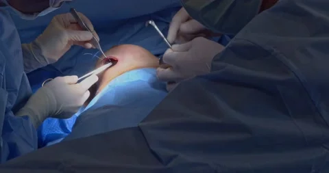 Breast implant replacement. Plastic surgery. Wound suturing Stock Footage 204028095