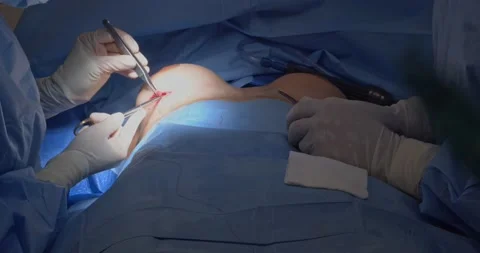 Breast implant replacement. Plastic surgery Vídeo Stock 204028358