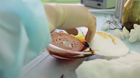 Breast implants before the operation 스톡 동영상 64627103