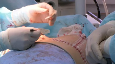 Breast lift surgery Stockbeeldmateriaal 67490803