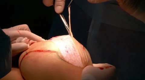 Breast lift surgery Stock Footage 67490877