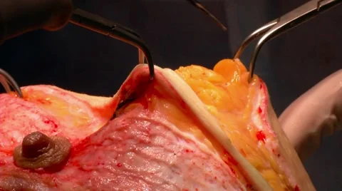 Breast lift surgery Stock Footage 67490891