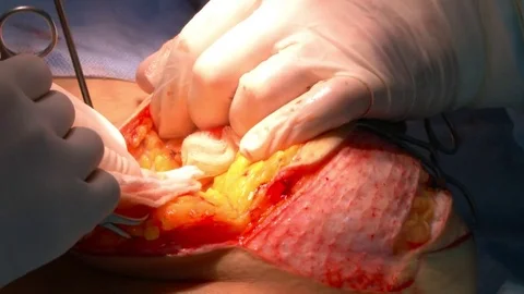 Breast lift surgery Stock Footage 71447652