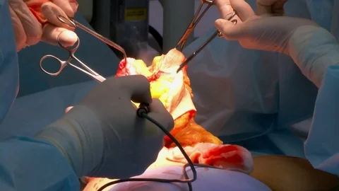 Breast lift surgery Video stock 76637388