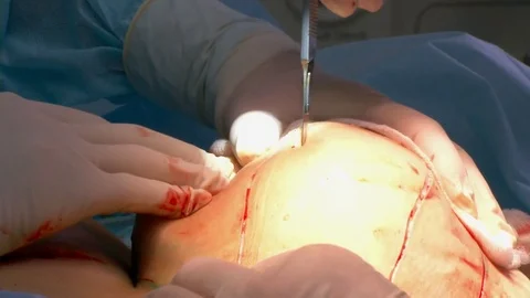 Breast lift surgery Stock Footage 76925984