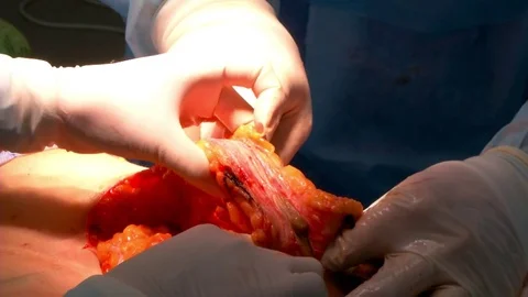 Breast lift surgery Video stock 79213713