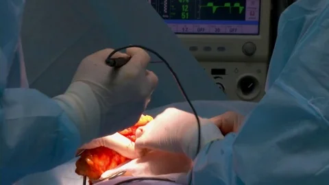 Breast lift surgery Video stock 79526488