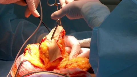 Breast lift surgery Video stock 80324723