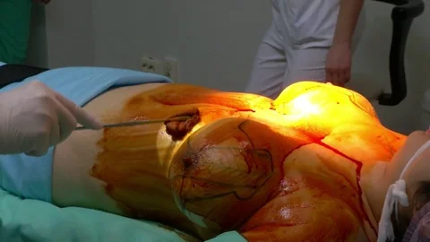 Breast lift surgery Stockbeeldmateriaal 80324852