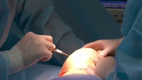 Breast lift surgery Video stock 80325012