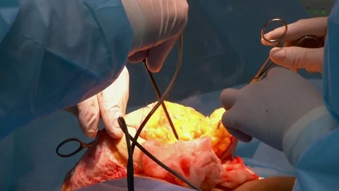 Breast lift surgery Video stock 80325099