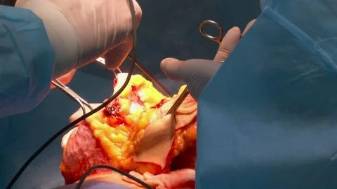 Breast lift surgery Stock Footage 80325208