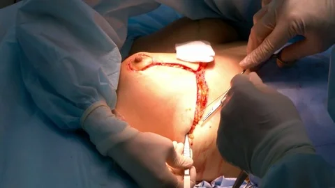 Breast lift surgery Video stock 80325261