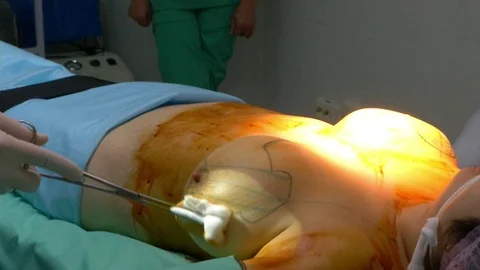 Breast lift surgery Video stock 80325314