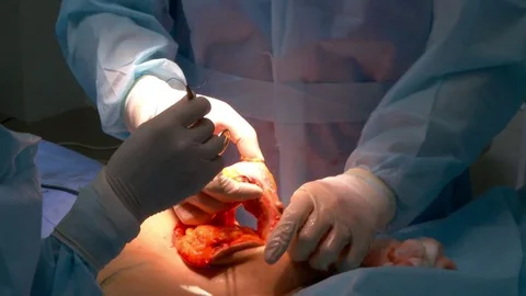 Breast lift surgery Stock Footage 80483361