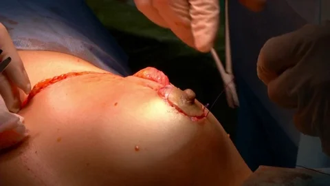 Breast lift surgery Stock Footage 83873305