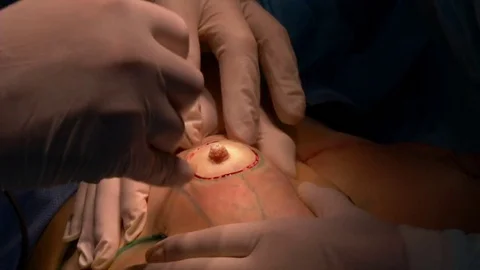 Breast lift surgery Stock Footage 83873342