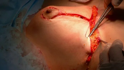 Breast lift surgery Stock Footage 84190727