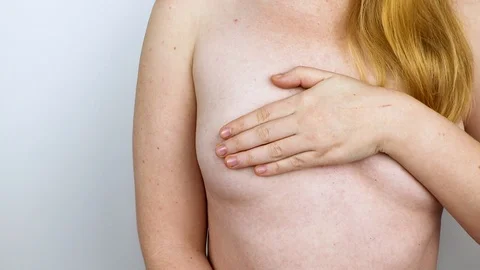 Breast plastic surgery - plastic breast augmentation surgery. The doctor prepare Stock Footage 103657904