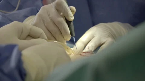 Breast surgery Video stock 222034855