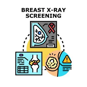 Breast x ray screening detecting cancer and tumor development Stock Illustration
