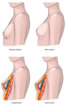Breasts implants Stock Illustration