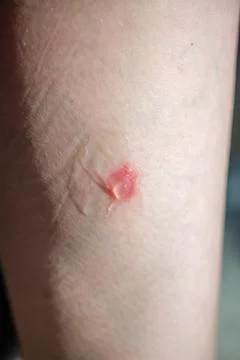 A bright bite from an insect on a person's leg, lubricated with a transpare.. Stock Photos