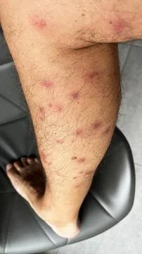 Bright red marks from insect bites on male human legs. Cercaria bite Stock Photos