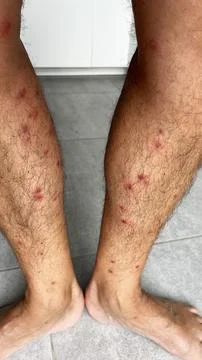 Bright red marks from insect bites on male human legs. Cercaria bite Stock Photos
