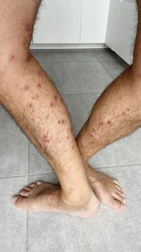Bright red marks from insect bites on male human legs. Cercaria bite Stock Photos