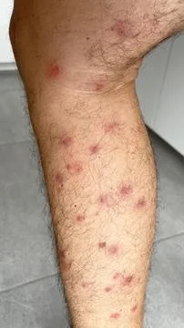 Bright red marks from insect bites on male human legs. Cercaria bite Stock Photos