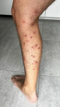 Bright red marks from insect bites on male human legs. Cercaria bite Stock Photos