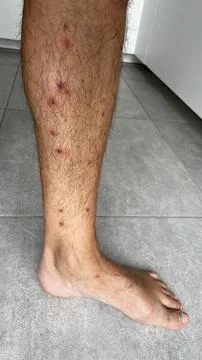 Bright red marks from insect bites on male human legs. Cercaria bite Stock Photos